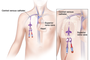 What a Tunneled Central Venous Catheter (CVC) Taught Me About Healthcare