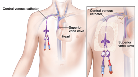 What a Tunneled Central Venous Catheter (CVC) Taught Me About Healthcare