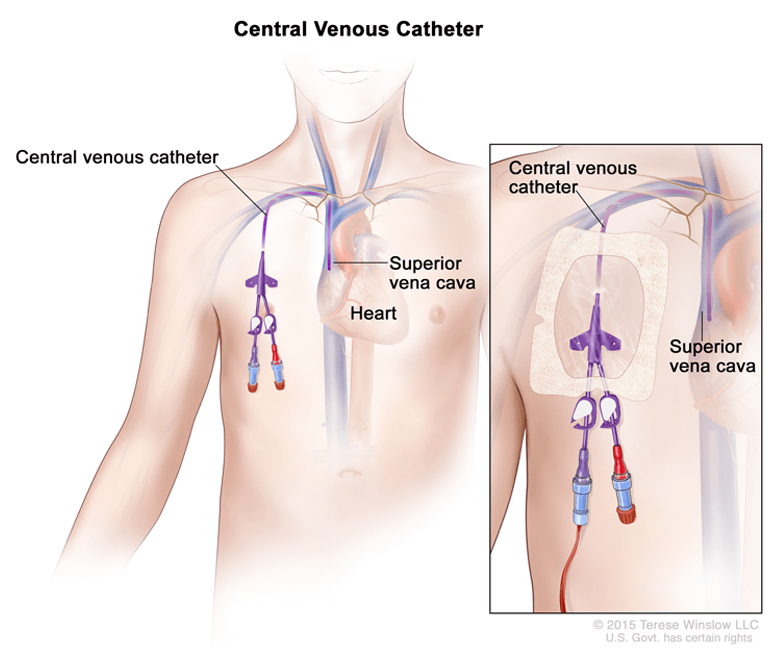 What a Tunneled Central Venous Catheter (CVC) Taught Me About Healthcare